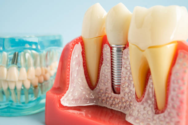 Best Periodontal (Gum) Disease Treatment  in Pierce, NE